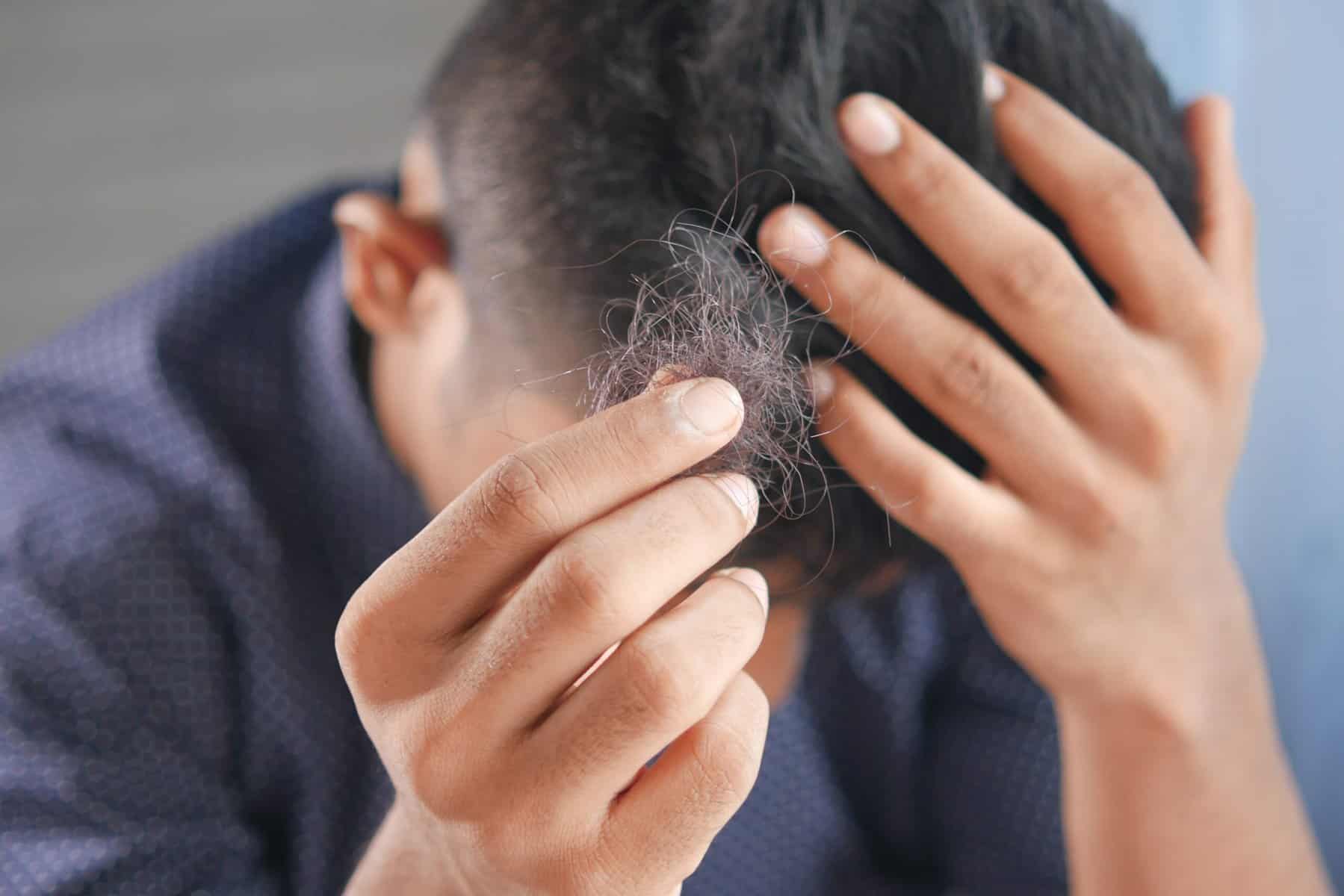 Hair Loss Treatment Options For You From The Experts Desk