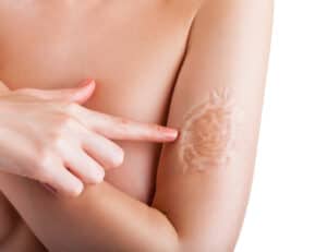 , Treatments