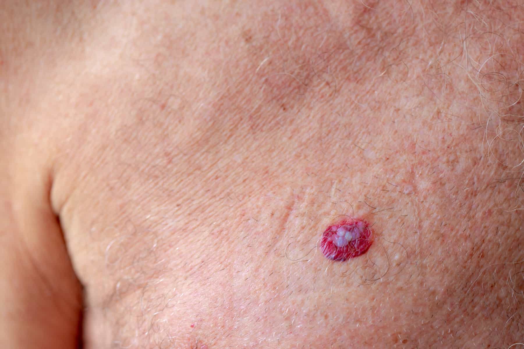 Is Basal Cell Carcinoma on the Rise? | Harley Street Dermatologists