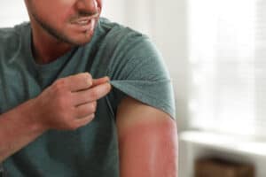 , Actinic Keratosis
