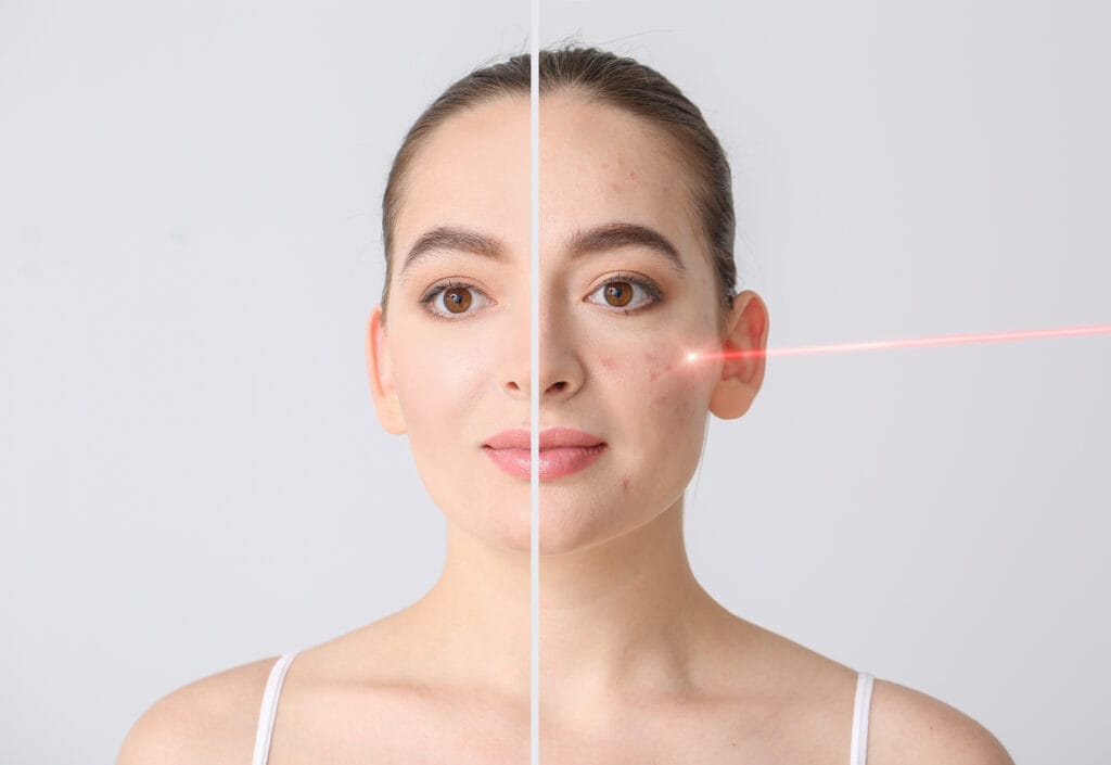 Is Acne Scar Laser Treatment Permenant? Harley St Dermatology Clinic