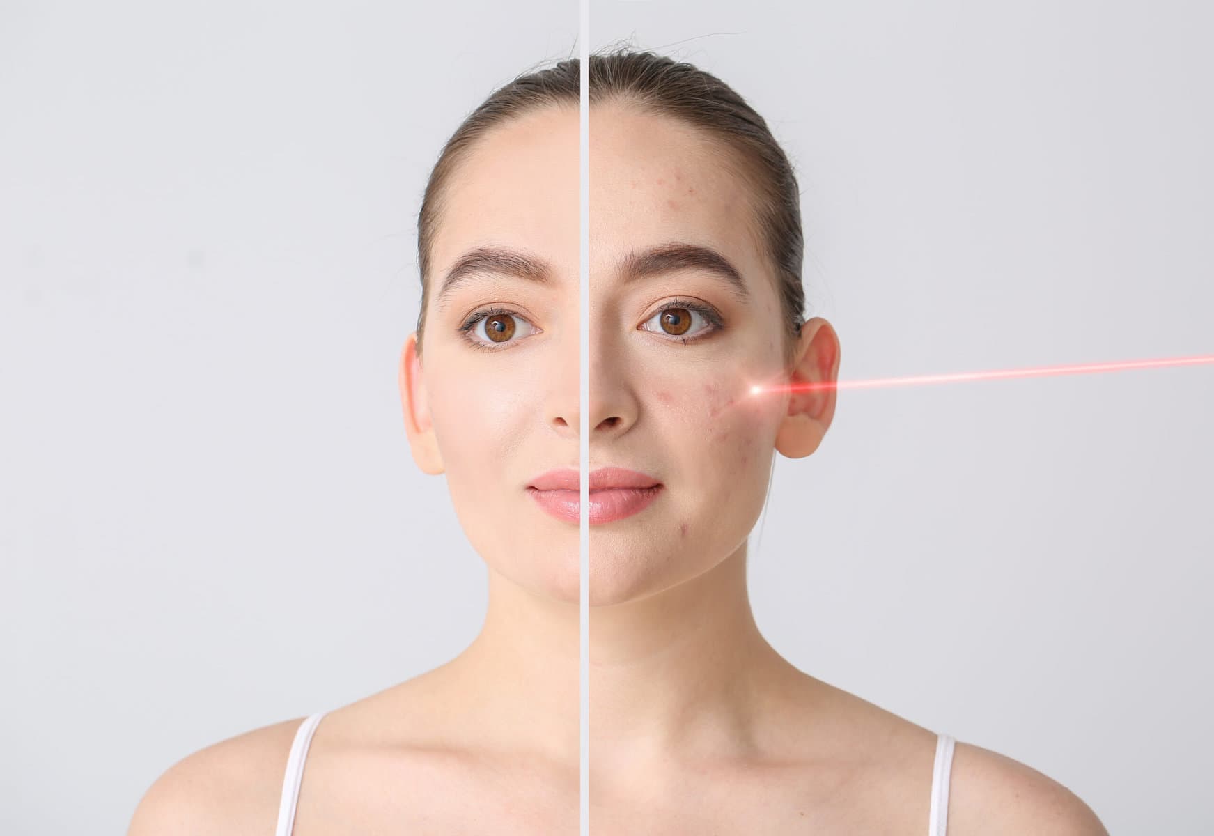 Laser treatment for shop acne scars cost