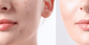 , Bespoke Dermatology Facial
