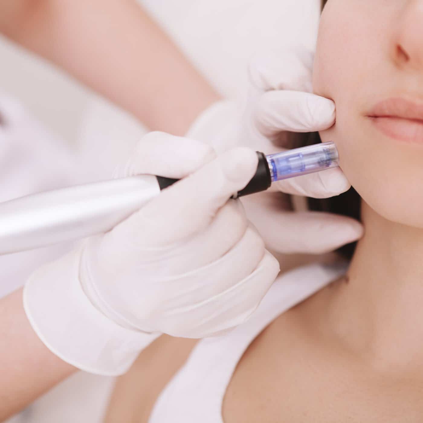 Microneedling Scaled