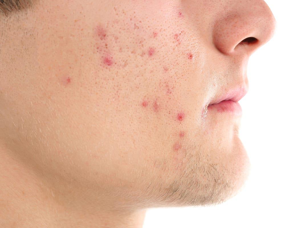 , Cyst Removal London
