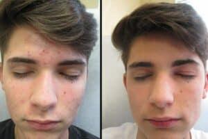acne-before-after-600x400-1.jpeg