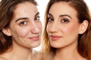 acne-treatment-oxford-results-scaled-600x400-1.jpeg