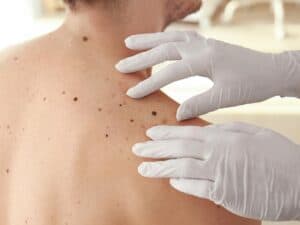 , Actinic Keratosis
