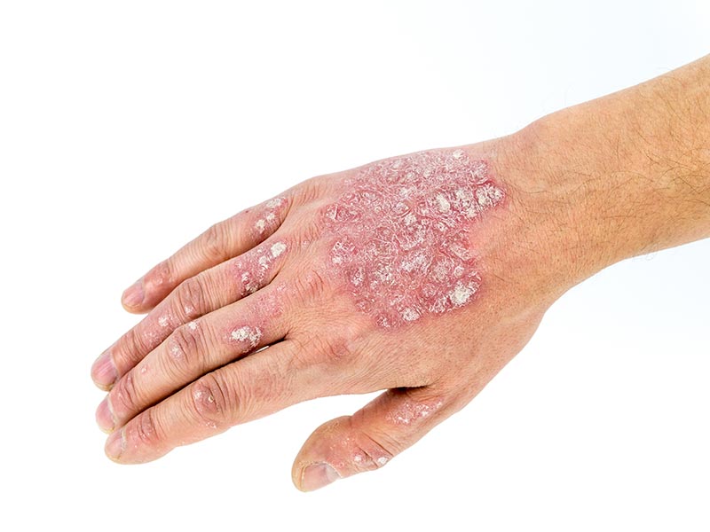 Psoriasis-Large-1.jpg