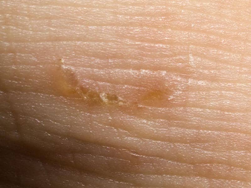 Scabies-Large-5.jpg