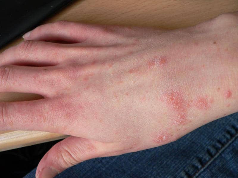 Scabies-Large-6.jpg