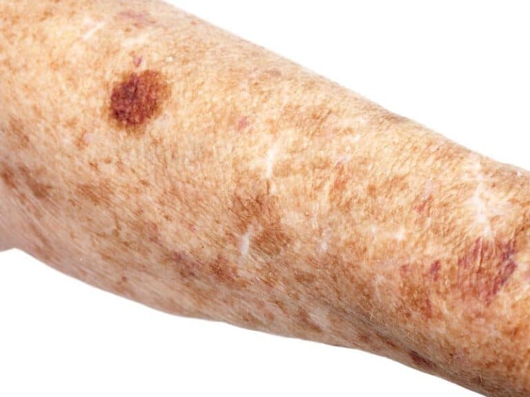 Freckles And Solar Lentigos Harley Street Dermatology Clinic Freckles And Solar Lentigos Harley Street Dermatology Clinic