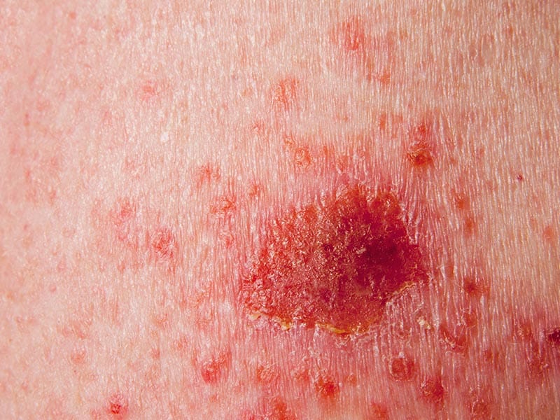 Squamous-Carcinoma-Large-1.jpg