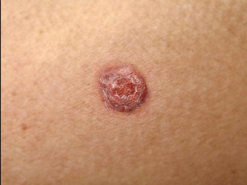 Squamous-Carcinoma-Large-6-1.jpg