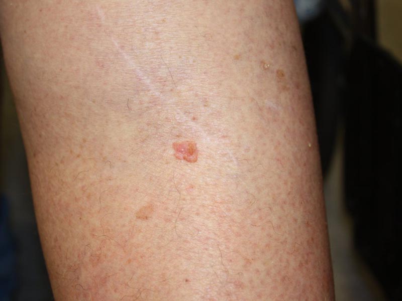 Squamous-Carcinoma-Large-7.jpg