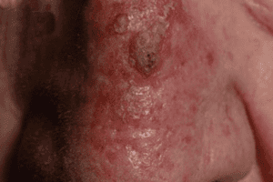 acitinic-k-before-300x200-1.png