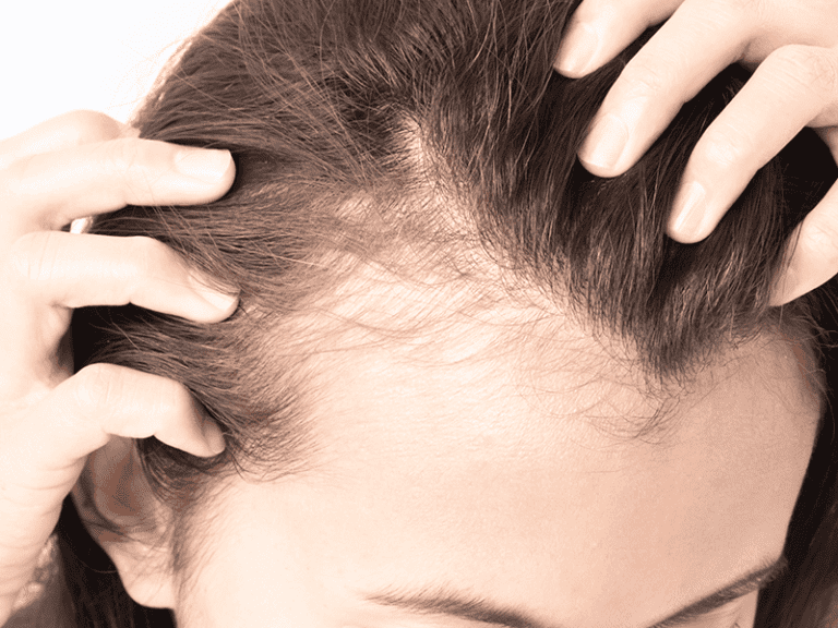 alopecia_0002_AdobeStock_135718523-1.png
