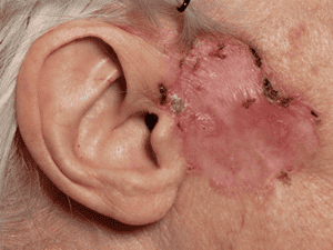 , Skin Cancer Blogs