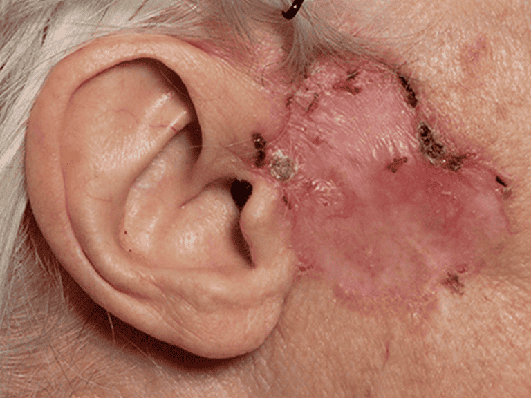 basalcellcarcinoma_0001_Basal-Cell-Carcinoma-5-large.png