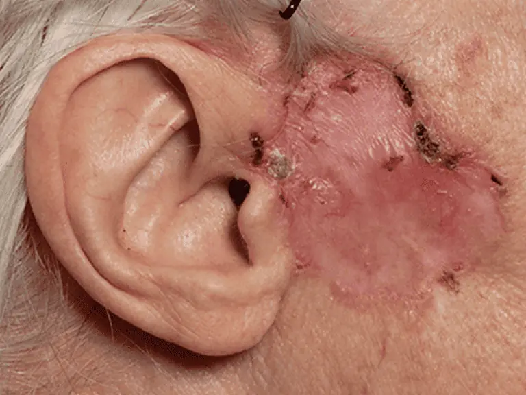 basalcellcarcinoma_0001_Basal-Cell-Carcinoma-5-large.png