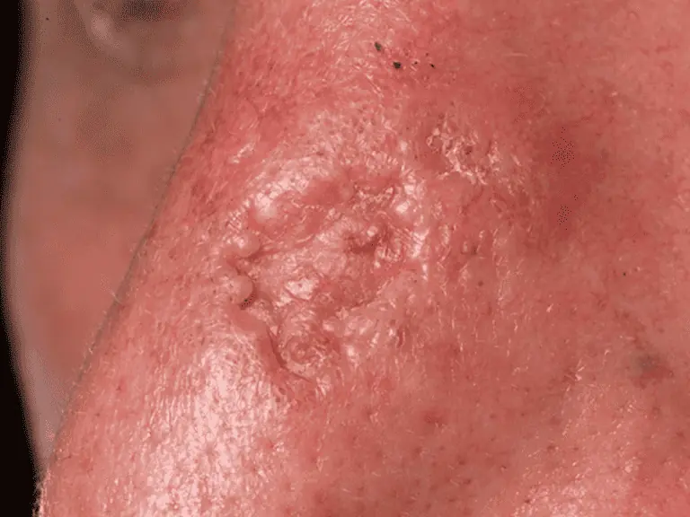 basalcellcarcinoma_0002_Basal-Cell-Carcinoma-4-large.png