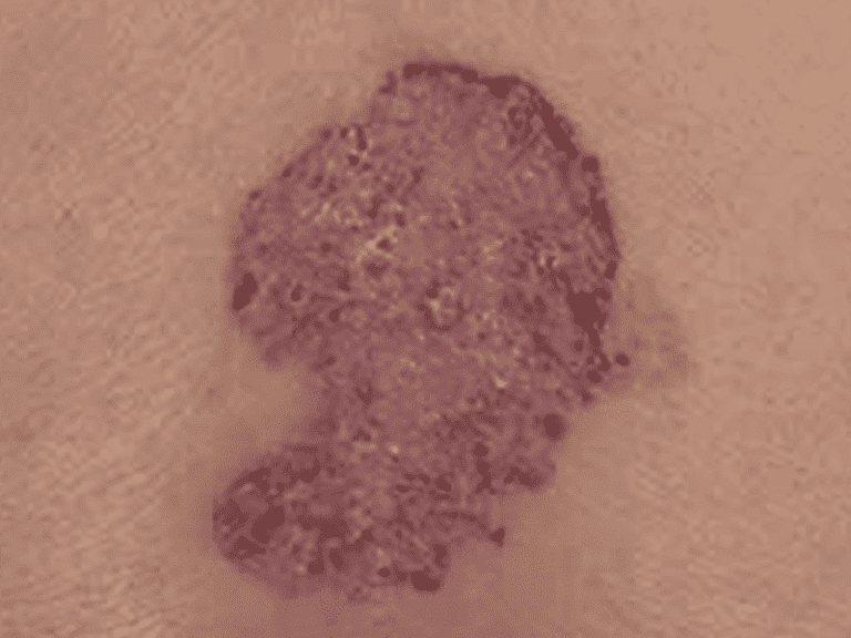 basalcellcarcinoma_0004_Basal-Cell-Carcinoma-2.png