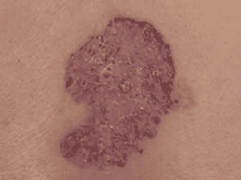 basalcellcarcinoma_0004_Basal-Cell-Carcinoma-2.png