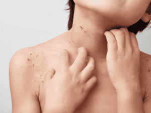 , Treatments