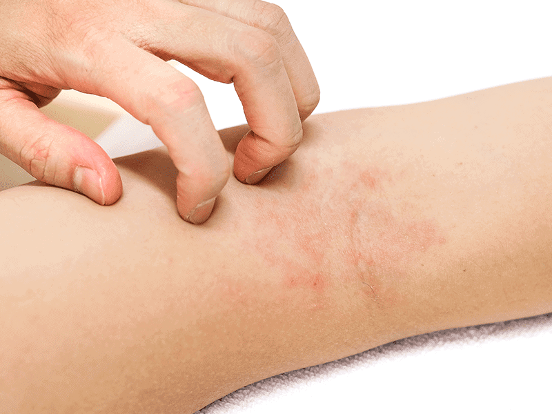 eczema specialist in london