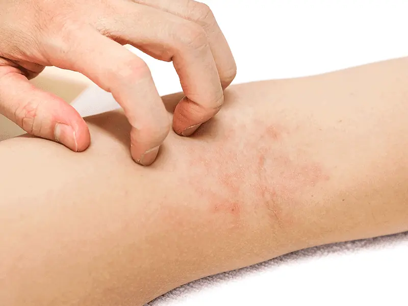 eczema specialist in london
