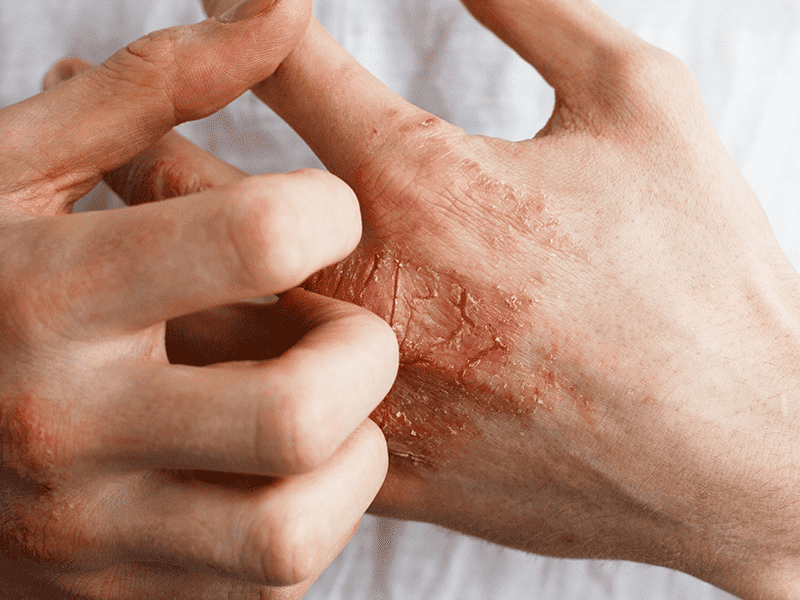 eczema_0002_AdobeStock_137327355.png