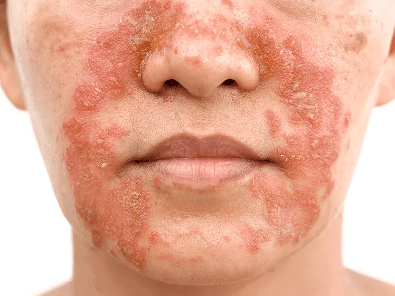 eczema_0003_AdobeStock_195864178.png