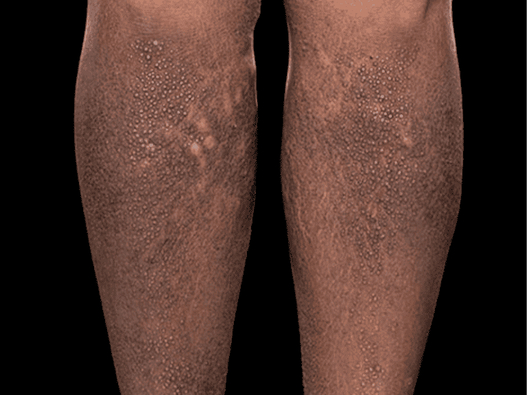 eczema_0005_Lichen-amyloid-eczema-large.png