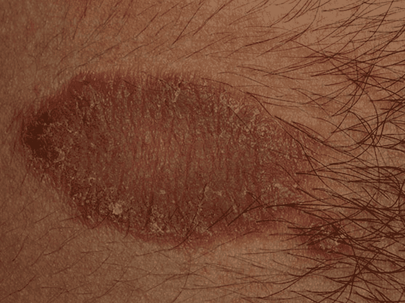 eczema_0006_Discoid-Eczema-large.png