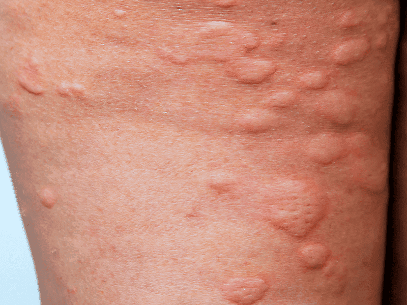 Why Is My Body Itchy With Hives At Humberto Watts Blog