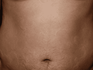 hives_0000_hives-300x225-1.png