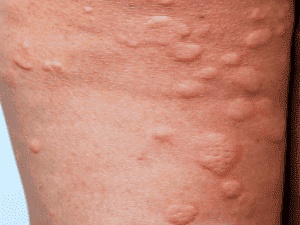 hives_0002_AdobeStock_243131546-300x225-1.png