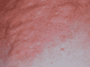 hives_0003_AdobeStock_242794575-300x225-1.png