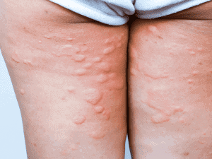 hives_0004_AdobeStock_236739309-300x225-1.png