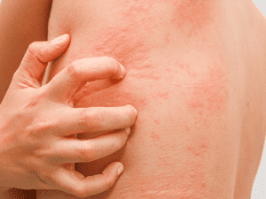 hives_0006_AdobeStock_119502501-300x225-1.png