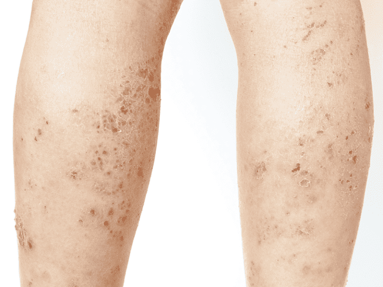 lichen-planus.png