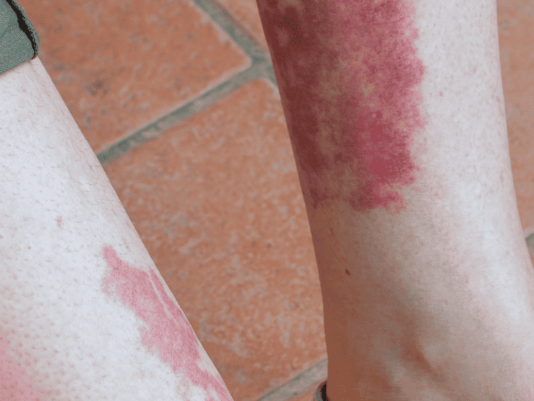 lichenplanus2.png