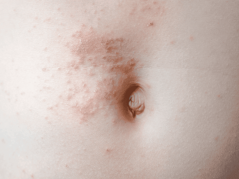 scabies.png