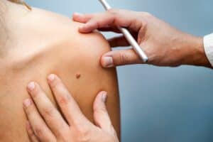 , Treatments