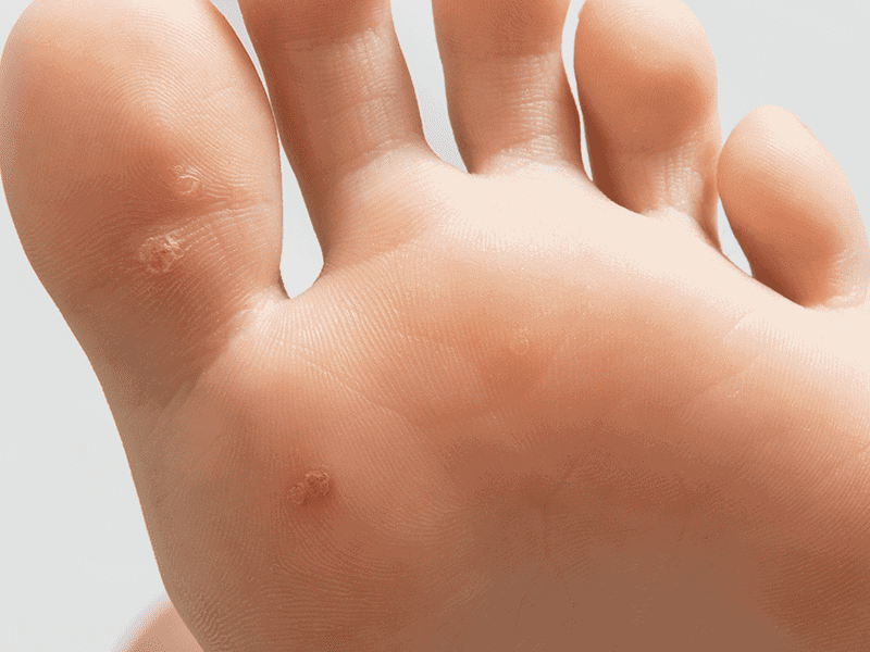 wartsandverrucas_0001_AdobeStock_243290969.png