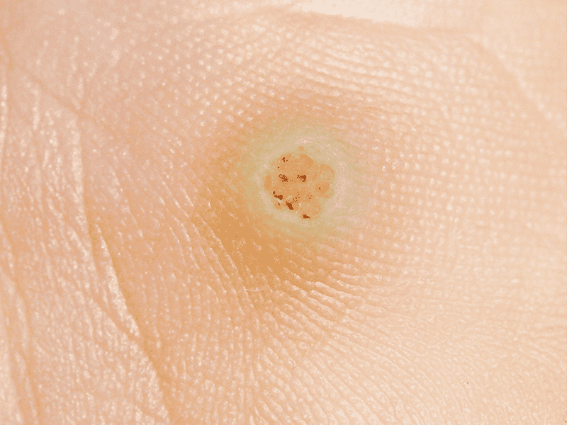 wartsandverrucas_0008_AdobeStock_68675895.png