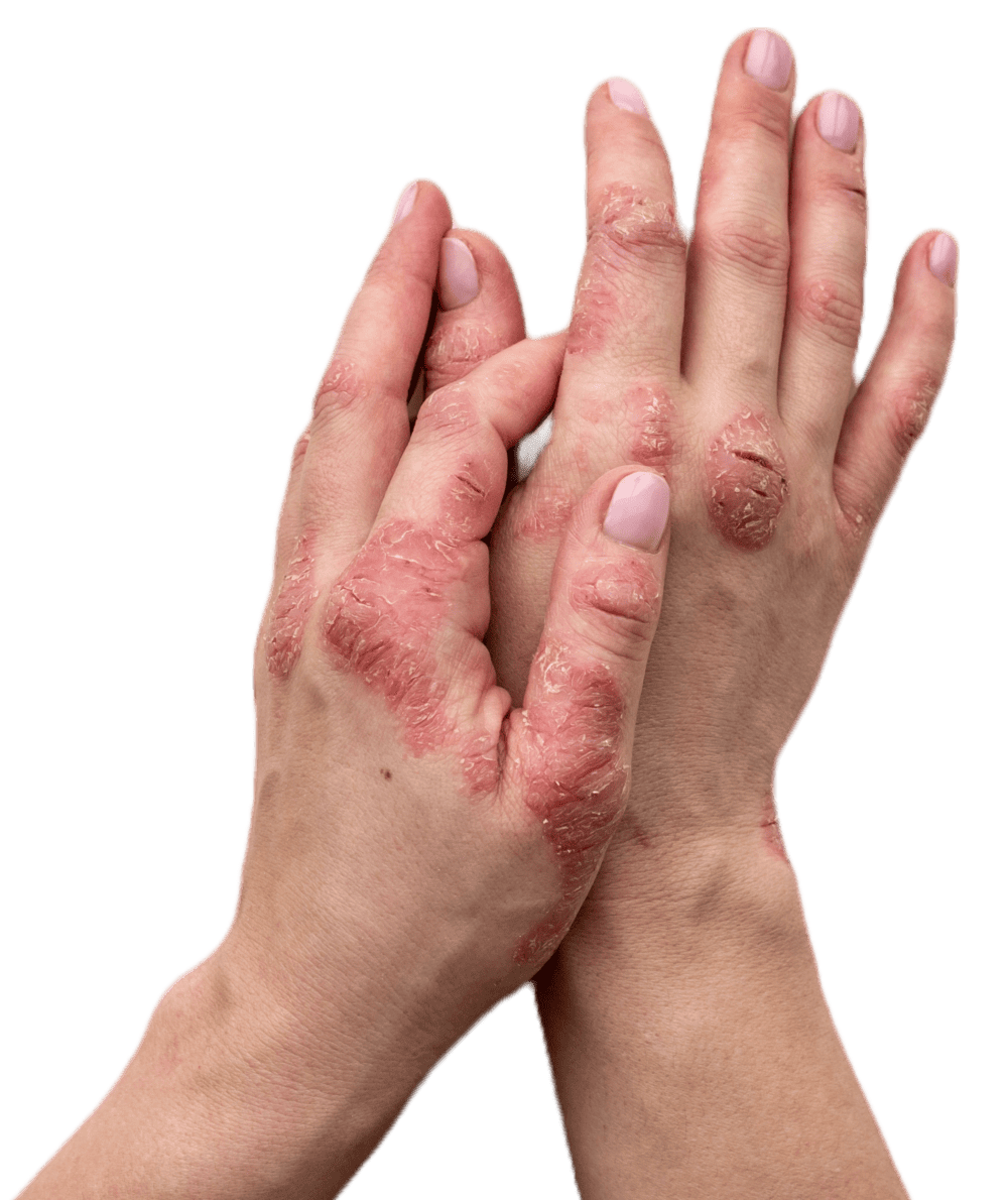 psoriasis treatment London