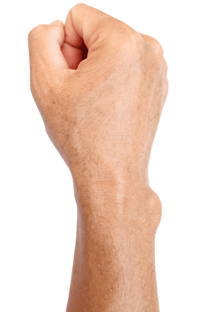 Private Lipoma Removal In London