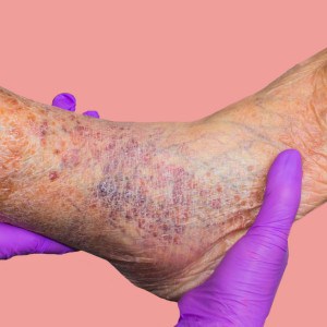 Varicose veins London