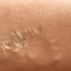 Varicose veins medical treatment London